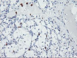 IHC of paraffin-embedded Carcinoma of Human kidney tissue using anti-USP36 mouse monoclonal antibody.