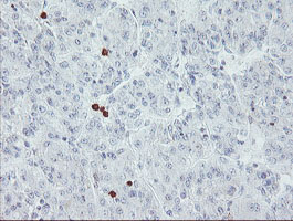 IHC of paraffin-embedded Carcinoma of Human liver tissue using anti-USP36 mouse monoclonal antibody.