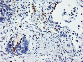 IHC of paraffin-embedded Carcinoma of Human lung tissue using anti-USP36 mouse monoclonal antibody.