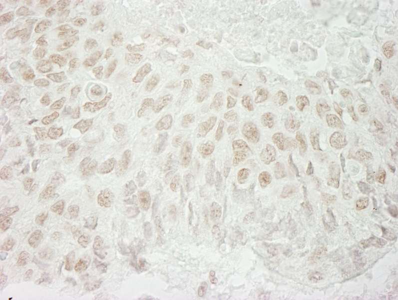 Detection of Human USP37 by Immunohistochemistry. Sample: FFPE section of human non-small cell lung cancer. Antibody: Affinity purified rabbit anti-USP37 used at a dilution of 1:1000 (1 ug/ml). Detection: DAB.