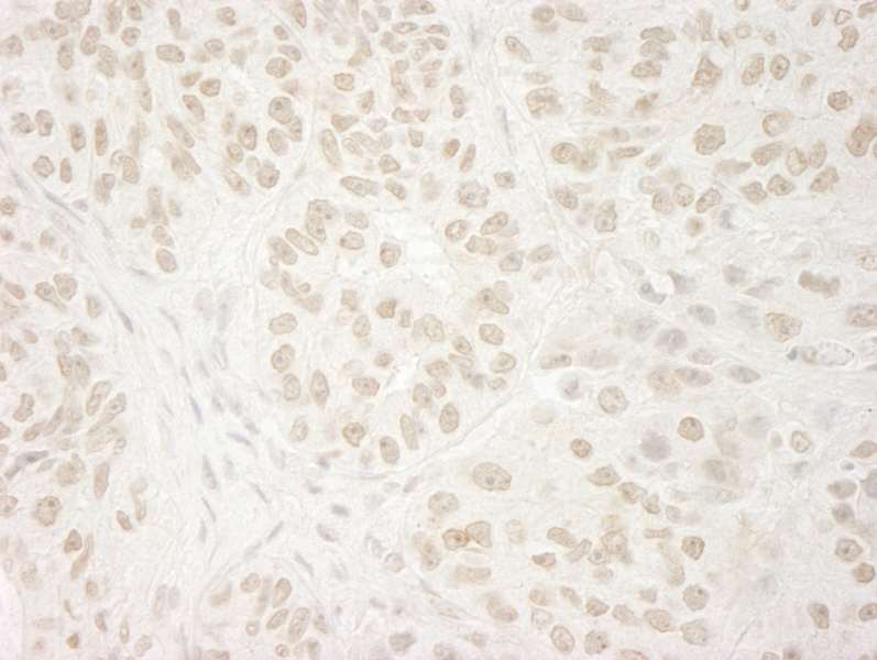 Detection of Human USP37 by Immunohistochemistry. Sample: FFPE section of human ovarian carcinoma. Antibody: Affinity purified rabbit anti-USP37 used at a dilution of 1:250. Epitope Retrieval Buffer-High pH (IHC-101J) was substituted for Epitope Retrieval Buffer-Reduced pH.