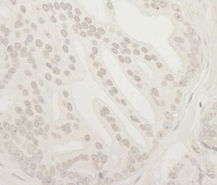 Detection of Human USP37 by Immunohistochemistry. Sample: FFPE section of human prostate carcinoma. Antibody: Affinity purified rabbit anti-USP37 used at a dilution of 1:250. Epitope Retrieval Buffer-High pH (IHC-101J) was substituted for Epitope Retrieval Buffer-Reduced pH.