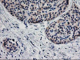 IHC of paraffin-embedded Carcinoma of Human pancreas tissue using anti-TMOD1 mouse monoclonal antibody. (Heat-induced epitope retrieval by 10mM citric buffer, pH6.0, 100C for 10min).
