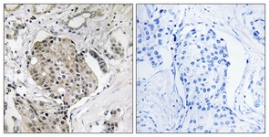 IHC of paraffin-embedded human breast carcinoma, using USP40 Antibody. The sample on the right was incubated with synthetic peptide.