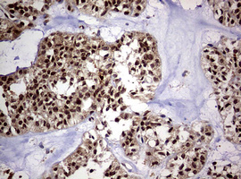 IHC of paraffin-embedded Carcinoma of Human pancreas tissue using anti-USP44 mouse monoclonal antibody. (Heat-induced epitope retrieval by 10mM citric buffer, pH6.0, 120°C for 3min).