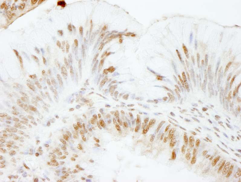 Detection of Human USP47 by Immunohistochemistry. Sample: FFPE section of human colon carcinoma. Antibody: Affinity purified rabbit anti-USP47 used at a dilution of 1:1000 (1 ug/ml). Detection: DAB.