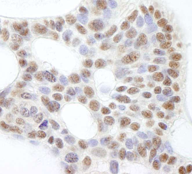 Detection of Human USP47 by Immunohistochemistry. Sample: FFPE section of human basal cell carcinoma. Antibody: Affinity purified rabbit anti-USP47 used at a dilution of 1:500.