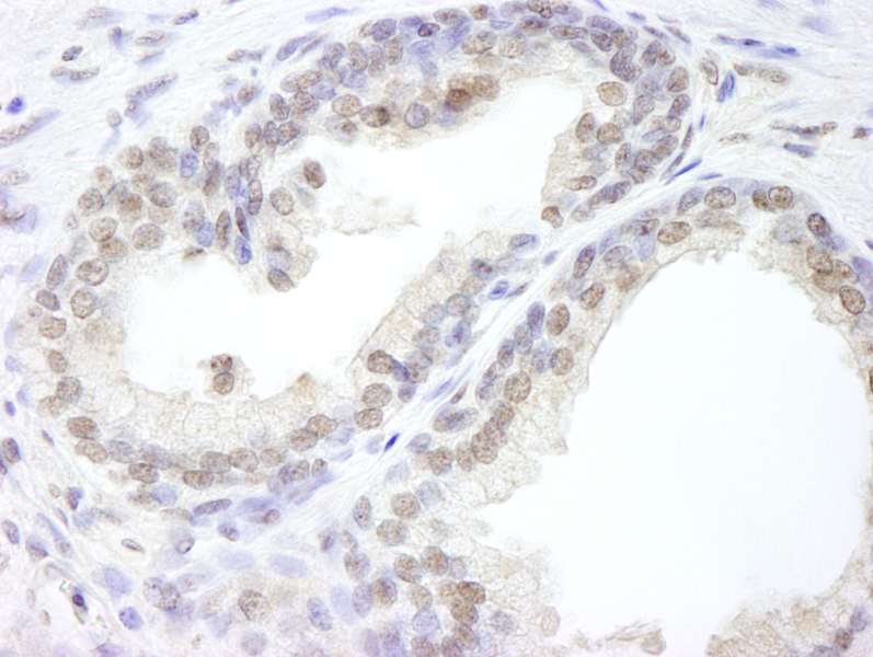 Detection of Human USP47 by Immunohistochemistry. Sample: FFPE section of human prostate carcinoma. Antibody: Affinity purified rabbit anti-USP47 used at a dilution of 1:500.