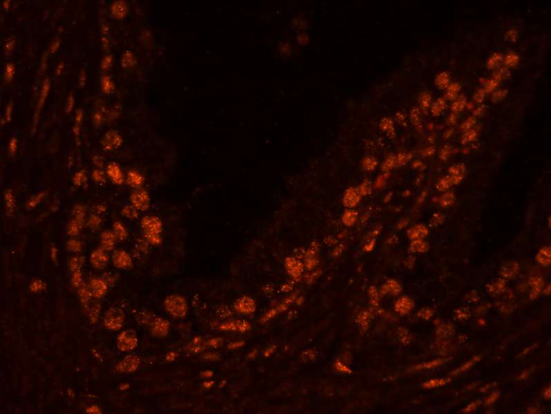 Detection of Human USP47 by Immunofluorescence. Sample: FFPE section of human prostate adenocarcinoma. Antibody: Affinity purified rabbit anti-USP47 used at a dilution of 1:100. Detection: Red-fluorescent Alexa Fluor 555 goat anti-rabbit IgG (Invitrogen) used at a dilution of 1:500.