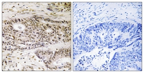 IHC of paraffin-embedded human colon carcinoma tissue, using USP48 Antibody. The sample on the right was incubated with synthetic peptide.