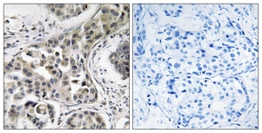 IHC of paraffin-embedded human breast carcinoma, using USP6NL Antibody. The picture on the right is treated with the synthesized peptide.