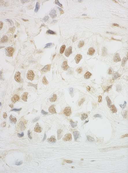 Detection of Human HCA66 by Immunohistochemistry. Sample: FFPE section of human breast carcinoma. Antibody: Affinity purified rabbit anti-HCA66 used at a dilution of 1:500.
