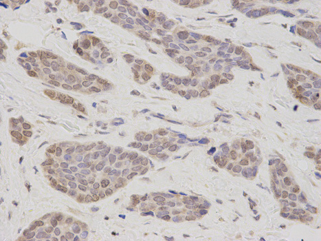 Immunohistochemistry of paraffin-embedded human endometrial cancer using TMPO antibody at dilution of 1:200 (400x lens)
