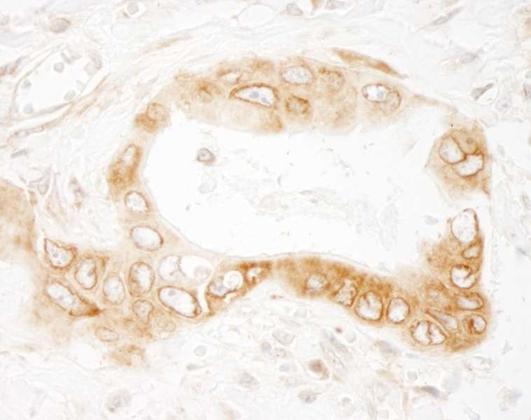 Detection of Human UVRAG by Immunohistochemistry. Sample: FFPE section of human colon carcinoma. Antibody: Affinity purified rabbit anti-UVRAG used at a dilution of 1:200 (1 ug/ml). Detection: DAB.
