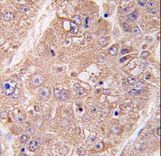 Formalin-fixed and paraffin-embedded human hepatocarcinoma tissue reacted with hUVRAG , which was peroxidase-conjugated to the secondary antibody, followed by DAB staining. This data demonstrates the use of this antibody for immunohistochemistry; clinical relevance has not been evaluated.