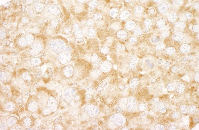 Detection of Mouse UVRAG by Immunohistochemistry. Sample: FFPE section of mouse renal cell carcinoma. Antibody: Affinity purified rabbit anti-UVRAG used at a dilution of 1:250. Epitope Retrieval Buffer-High pH (IHC-101J) was substituted for Epitope Retrieval Buffer-Reduced pH.