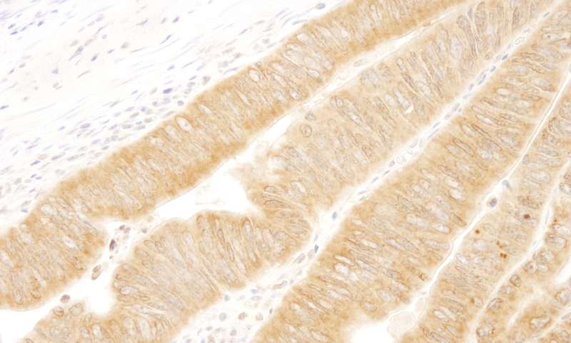Detection of Human UVRAG by Immunohistochemistry. Sample: FFPE section of human colon carcinoma. Antibody: Affinity purified rabbit anti-UVRAG used at a dilution of 1:250. Epitope Retrieval Buffer-High pH (IHC-101J) was substituted for Epitope Retrieval Buffer-Reduced pH.