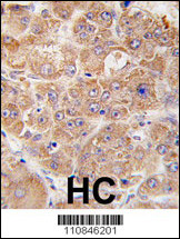 Formalin-fixed and paraffin-embedded human hepatocarcinoma tissue reacted with hUVRAG (N-term L133), which was peroxidase-conjugated to the secondary antibody, followed by DAB staining. This data demonstrates the use of this antibody for immunohistochemistry; clinical relevance has not been evaluated.