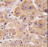 Formalin-fixed and paraffin-embedded human hepatocarcinoma tissue reacted with hUVRAG , which was peroxidase-conjugated to the secondary antibody, followed by DAB staining. This data demonstrates the use of this antibody for immunohistochemistry; clinical relevance has not been evaluated.