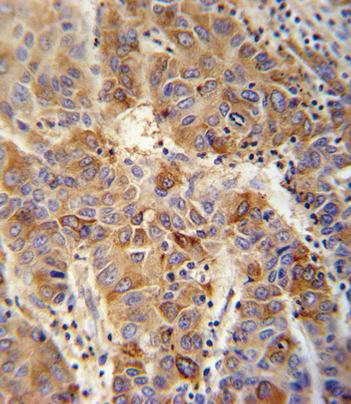 VAMP4 antibody immunohistochemistry of formalin-fixed and paraffin-embedded human hepatocarcinoma followed by peroxidase-conjugated secondary antibody and DAB staining.