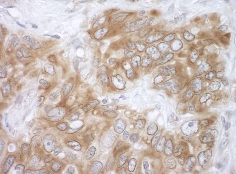 Detection of Human VAPB by Immunohistochemistry. Sample: FFPE section of human ovarian carcinoma. Antibody: Affinity purified rabbit anti-VAPB used at a dilution of 1:200 (1 ug/ml). Detection: DAB.