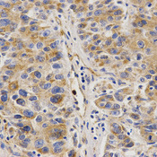 Immunohistochemistry of paraffin-embedded human liver cancer using VAPB antibody at dilution of 1:200 (x400 lens).