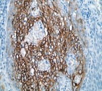 IHC of paraffin-embedded human cervical carcinoma using anti-Vav2 antibody.