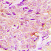 Immunohistochemical analysis of PIGF staining in human breast cancer formalin fixed paraffin embedded tissue section. The section was pre-treated using heat mediated antigen retrieval with sodium citrate buffer (pH 6.0). The section was then incubated with the antibody at room temperature and detected using an HRP conjugated compact polymer system. DAB was used as the chromogen. The section was then counterstained with hematoxylin and mounted with DPX.