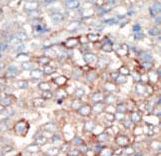 Formalin-fixed and paraffin-embedded human cancer tissue reacted with the primary antibody, which was peroxidase-conjugated to the secondary antibody, followed by DAB staining. This data demonstrates the use of this antibody for immunohistochemistry; clinical relevance has not been evaluated. BC = breast carcinoma; HC = hepatocarcinoma.