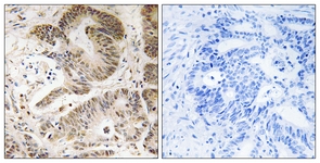 IHC of paraffin-embedded human colon carcinoma tissue, using PIK3R5 Antibody. The picture on the right is treated with the synthesized peptide.