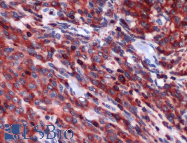 Human, Lung carcinoma: Formalin-Fixed, Paraffin-Embedded (FFPE)