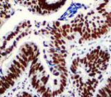 IHC of PMS2 on FFPE Colon Carcinoma tissue.