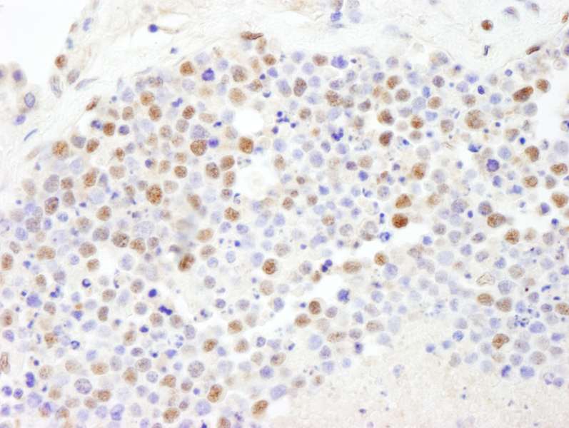 Detection of Human PolD3/p66 by Immunohistochemistry. Sample: FFPE section of human small cell lung cancer. Antibody: Affinity purified rabbit anti-PolD3/p66 used at a dilution of 1:1000 (1 ug/ml). Detection: DAB.