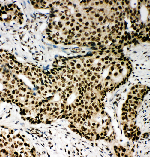 PPAR Alpha antibody. IHC(P): Human Breast Cancer Tissue.