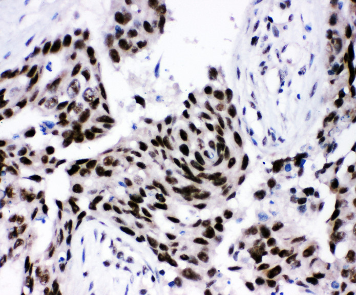 PPAR Alpha antibody. IHC(P): Human Breast Cancer Tissue.