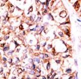 Formalin-fixed and paraffin-embedded human cancer tissue reacted with the primary antibody, which was peroxidase-conjugated to the secondary antibody, followed by AEC staining. This data demonstrates the use of this antibody for immunohistochemistry; clinical relevance has not been evaluated. BC = breast carcinoma; HC = hepatocarcinoma.