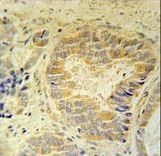 FAM105B Antibody immunohistochemistry of formalin-fixed and paraffin-embedded human prostate carcinoma followed by peroxidase-conjugated secondary antibody and DAB staining.