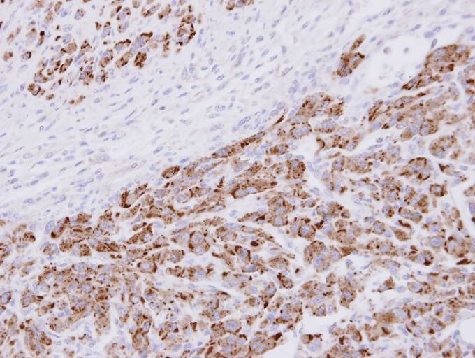 IHC of paraffin-embedded U87 xenograft using 20S Proteasome alpha3 antibody at 1:100 dilution.