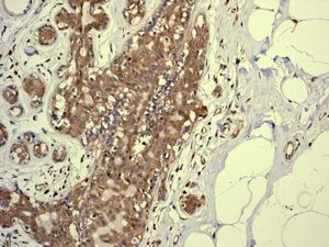 IHC of paraffin-embedded human breast carcinoma tissue using anti-PSMA7 antibody.