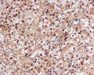 IHC of paraffin-embedded human kidney carcinoma tissue using anti-PSMA7 antibody.