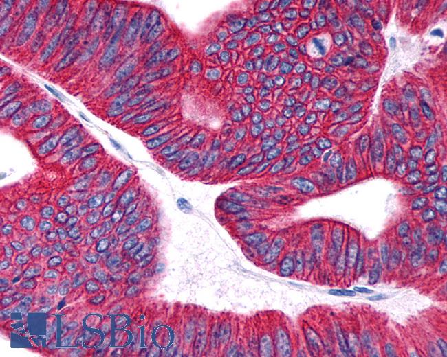 Anti-PTGDR / DP antibody IHC of human Colon, Carcinoma. Immunohistochemistry of formalin-fixed, paraffin-embedded tissue after heat-induced antigen retrieval.