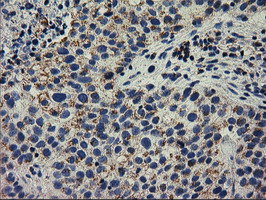 IHC of paraffin-embedded Carcinoma of Human bladder tissue using anti-RASD2 mouse monoclonal antibody. (Heat-induced epitope retrieval by 10mM citric buffer, pH6.0, 100C for 10min).