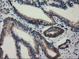 IHC of paraffin-embedded Carcinoma of Human prostate tissue using anti-RASD2 mouse monoclonal antibody. (Heat-induced epitope retrieval by 10mM citric buffer, pH6.0, 100C for 10min).