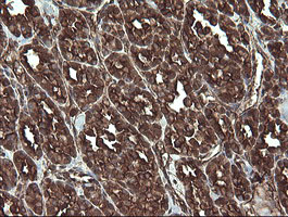 IHC of paraffin-embedded Carcinoma of Human thyroid tissue using anti-REEP5 mouse monoclonal antibody.