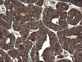 IHC of paraffin-embedded Adenocarcinoma of Human endometrium tissue using anti-REEP5 mouse monoclonal antibody.