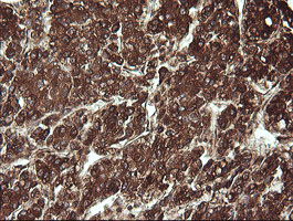 IHC of paraffin-embedded Carcinoma of Human liver tissue using anti-REEP5 mouse monoclonal antibody.