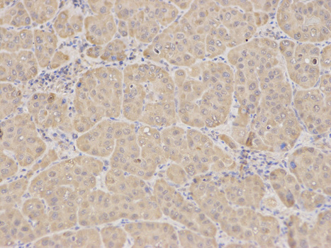 Immunohistochemistry of paraffin-embedded human liver cancer using RIPK2 antibody at dilution of 1:100 (200x lens).