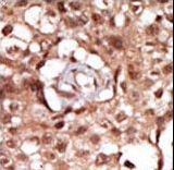 Formalin-fixed and paraffin-embedded human cancer tissue reacted with the primary antibody, which was peroxidase-conjugated to the secondary antibody, followed by AEC staining. This data demonstrates the use of this antibody for immunohistochemistry; clinical relevance has not been evaluated. BC = breast carcinoma; HC = hepatocarcinoma.