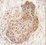 Formalin-fixed and paraffin-embedded human lung carcinoma tissue reacted with RIPK2 Antibody , which was peroxidase-conjugated to the secondary antibody, followed by DAB staining. This data demonstrates the use of this antibody for immunohistochemistry; clinical relevance has not been evaluated.