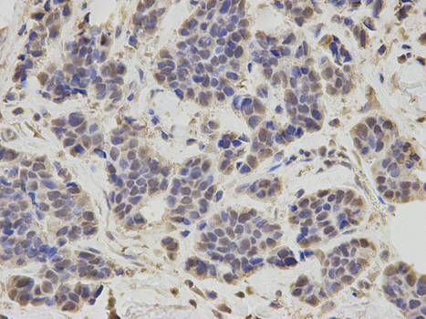 Immunohistochemistry of paraffin-embedded human breast cancer using RNF2 antibody at dilution of 1:200 (400x lens).